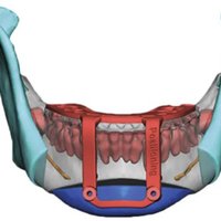3D SYSTEMS推出VSP混合颌面外科手术导板