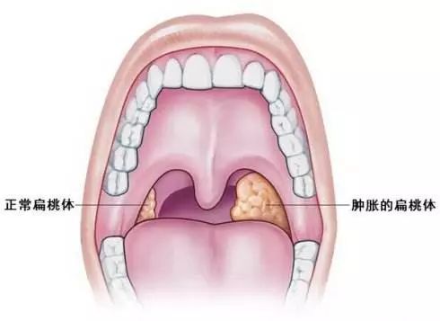 一发炎就发烧口气逼人吞口水都疼对付扁桃体发炎绝不是简单的割以永治