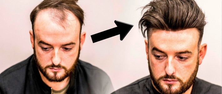  生发精华见效慢？试试这些立竿见影的秃秃好物！