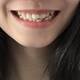 22岁少女的牙齿矫正日记（一）　