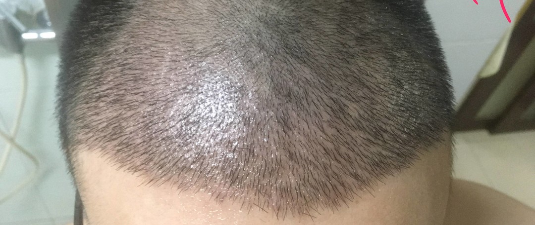 记录我的植发经历（三）植发后颜值黄金期