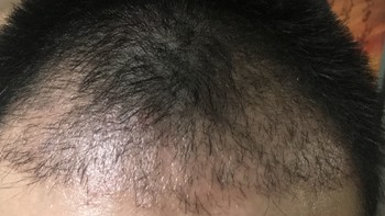 90后秃了——植发 篇四：植发后的脱发期（置换期） 