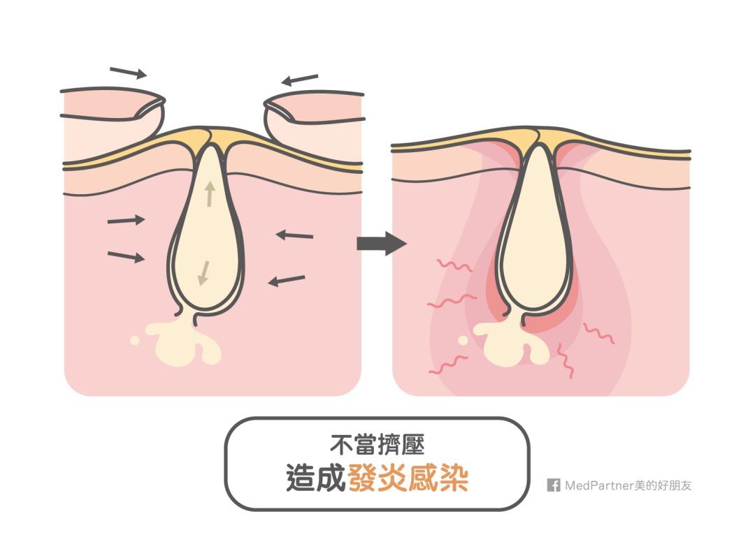 手贱党挤痘指南