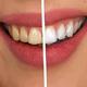  认真刷牙也只能清洁60%牙齿表面！直白无线洁牙器 让口腔更健康　