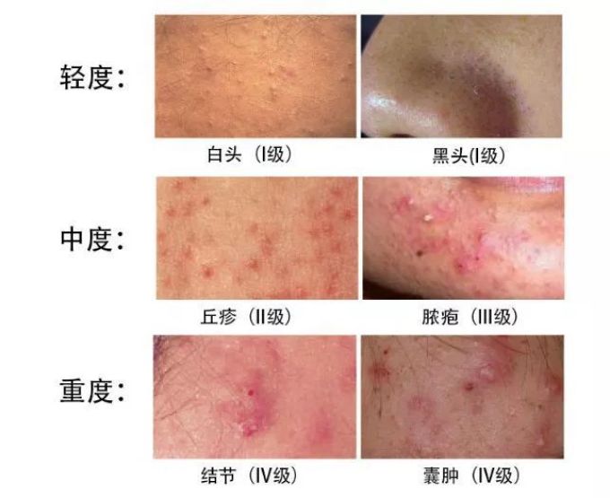 终结痘痘问题,这可能是全网最硬核的战痘手册