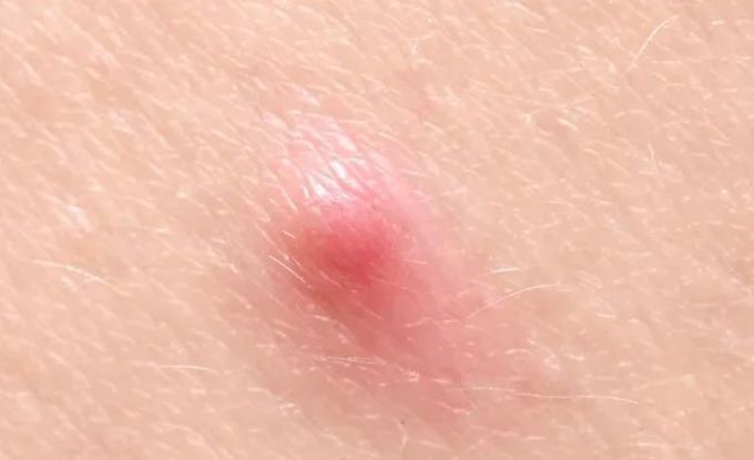 终结痘痘问题,这可能是全网最硬核的战痘手册