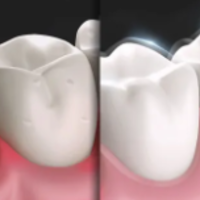 洗牙≠牙齿美白，你一定要知道它们的区别！