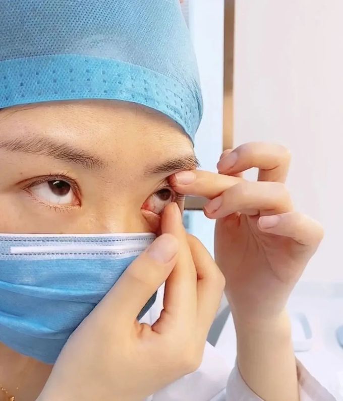 隐形眼镜应该怎么摘,80%的人都是错的!