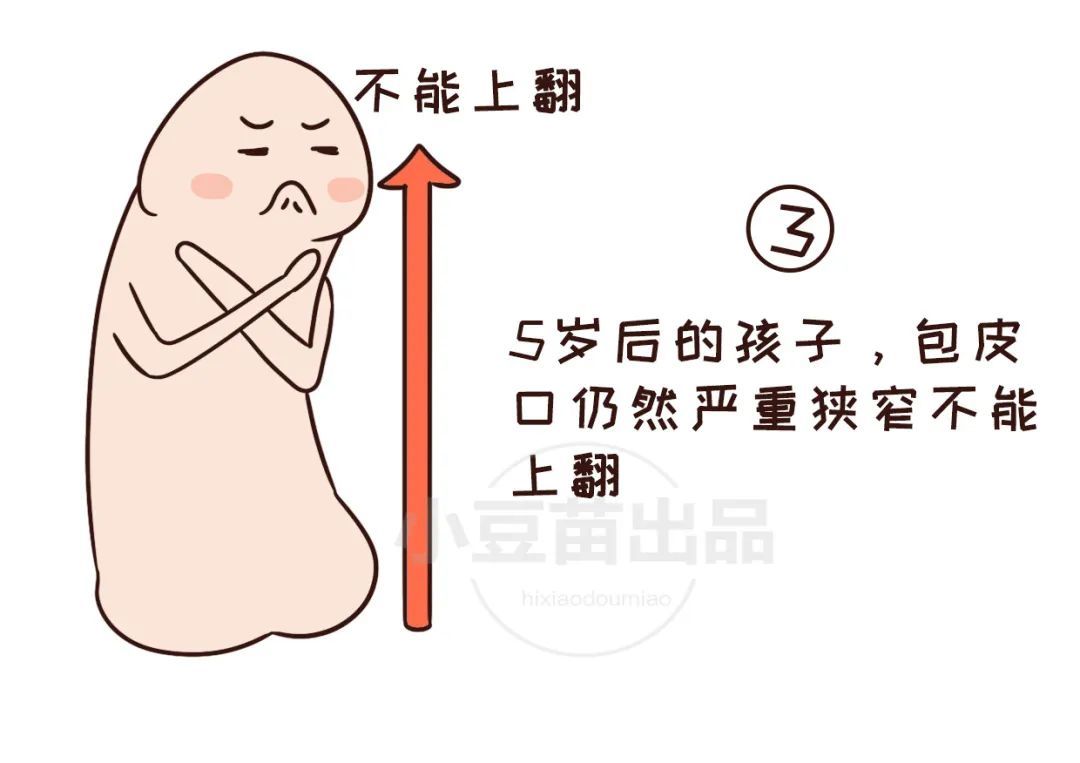 宝宝包皮要不要割？这3种情况爸妈需正视  附清洗以及护理方法