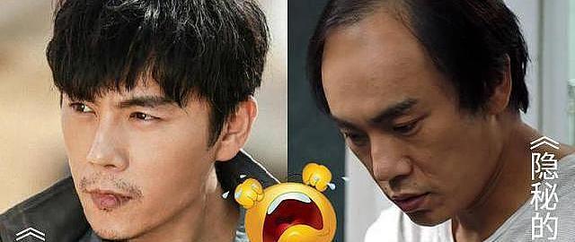 植发技术有哪几种 植发分为哪些技术 什么值得买