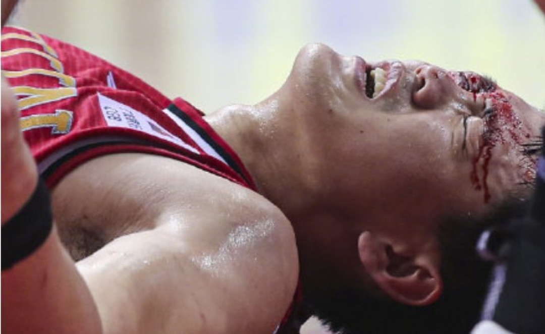 cba吉林队员眼部被抠血染赛场缝十针这动作你怎么看