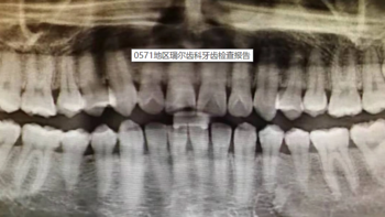 折腾自己 篇四：招商经典白权益——洗牙洗牙洗早早《信用卡交流贴》 