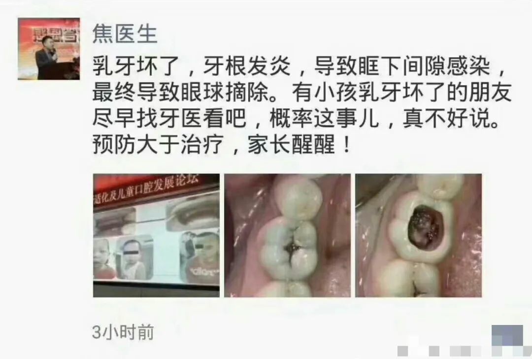 4岁孩子蛀牙竟要摘掉一只眼！关于乳牙护理爸爸妈妈要知道的7个真相