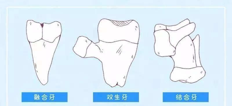 结合牙和融合牙的区别图片