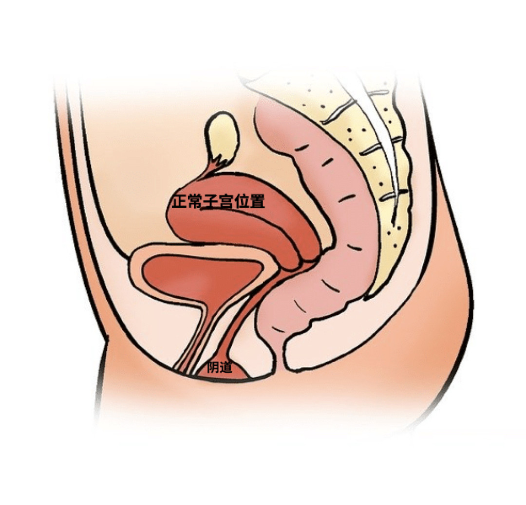 健康日历篇十六子宫脱垂究竟是怎样造成的