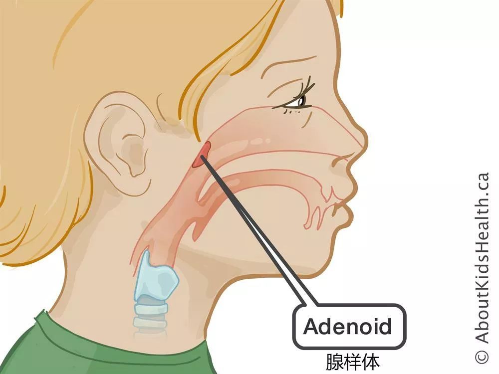 打呼噜、口呼吸的孩子，可能是腺体肥大！ 影响面容、身高、免疫力...