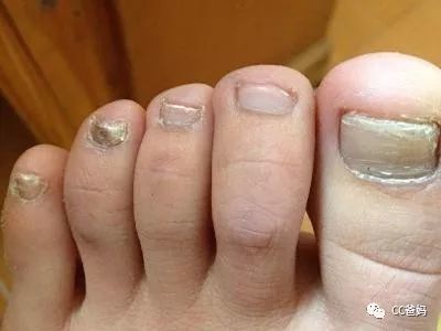 白点是肚里有蛔虫?竖纹是肠胃不好?一篇说清关于指甲的疑问!