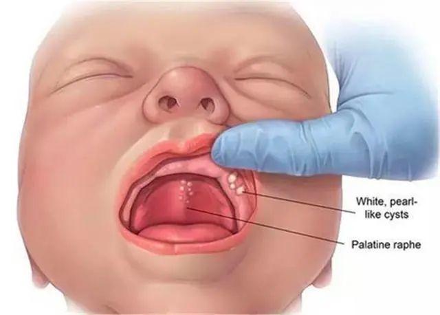新生儿正常嘴巴图图片