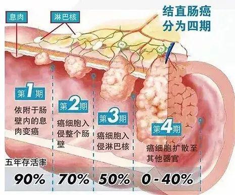 便秘、腹泻……各种“带薪拉屎”症状看过来，新技术解你“后”顾之忧