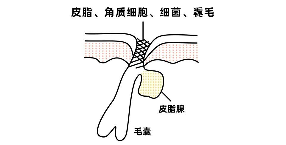 黑头究竟要怎么去？我们拔出并放大了四种类型的黑头…