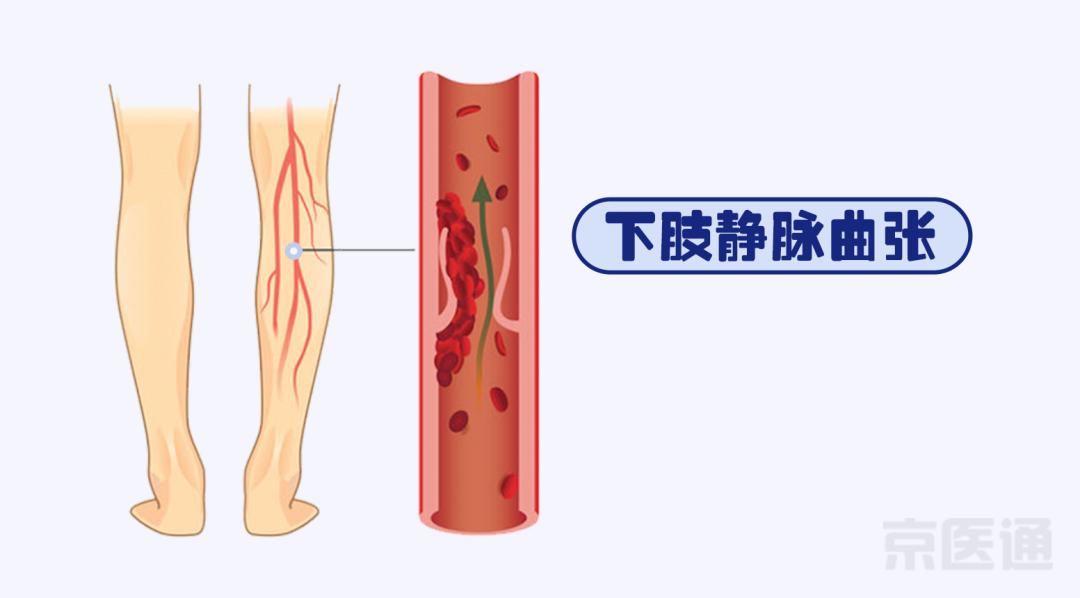 胃疼确诊肝癌？腿疼差点猝死？警惕误导我们的这些症状~