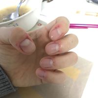 手指长甲周倒刺，是缺乏了维生素，还是身体出现了异常？