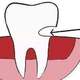 人到中年，警惕牙齿楔状缺损，说一说我的两次补牙经历