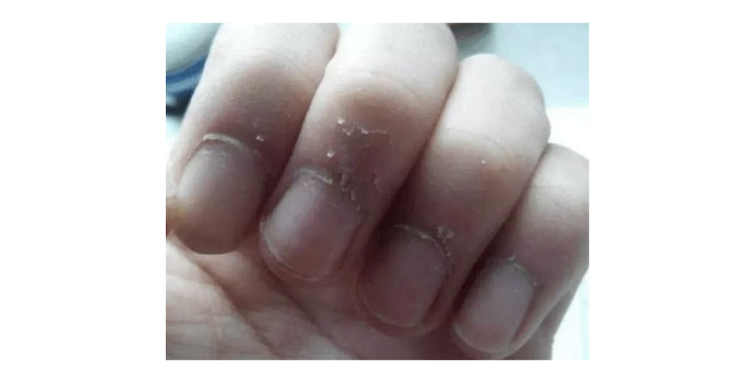 手指长甲周倒刺，是缺乏了维生素，还是身体出现了异常？
