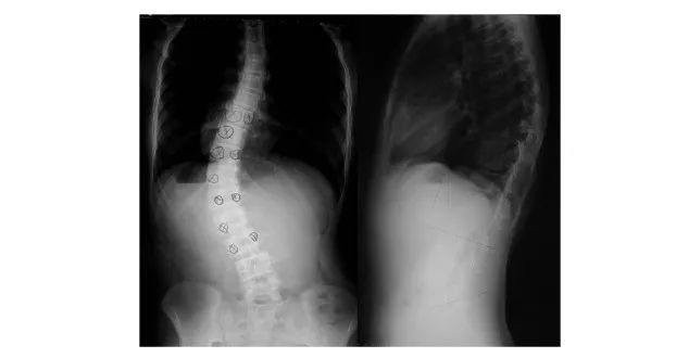 30%孩子都有“站没站相，坐没坐相”！脊柱侧弯要从小预防（附脊柱侧弯6步自测法）