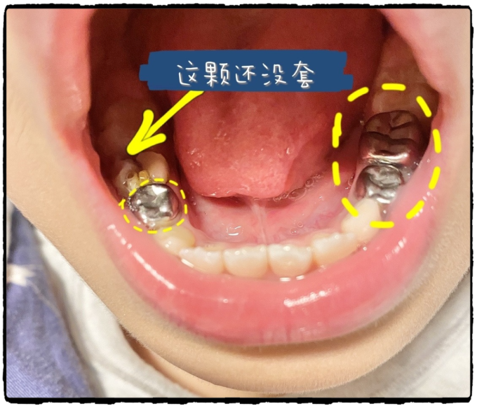 烧钱懊悔给娃套上4颗小钢牙后才醒悟