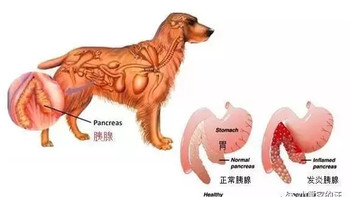 胰腺炎要低脂？到底多少才算低？