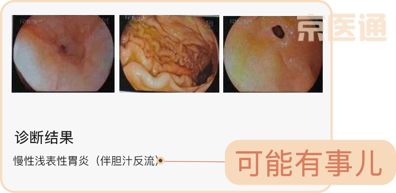 胃炎、肠化...离胃癌有多远？教你快速读懂胃镜报告！