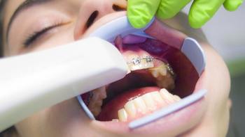 牙齿矫正怎么选牙套？各种牙套有哪些优劣势？这篇给你讲清楚