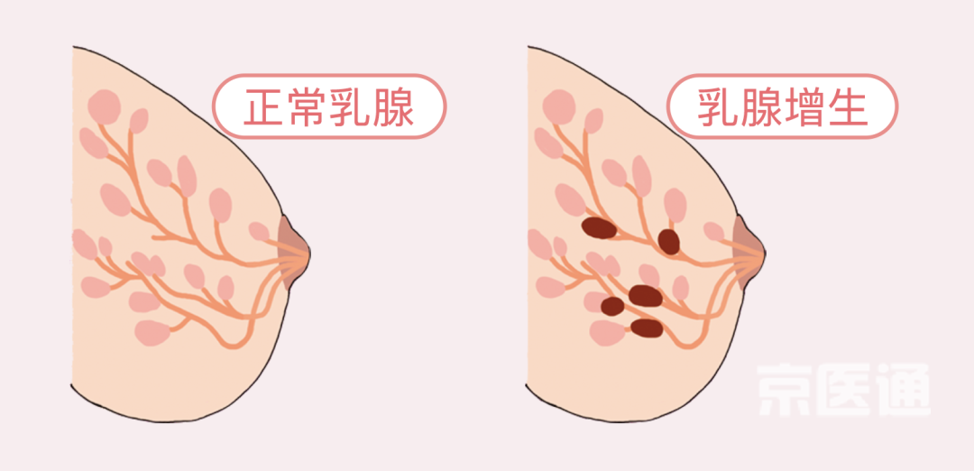 乳腺增生、结节、癌,摸起来是啥感觉?医生教你分辨(附自创护胸操)