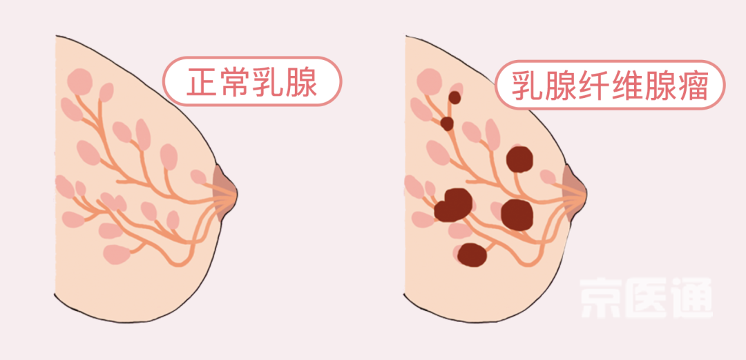 乳腺增生、结节、癌,摸起来是啥感觉?医生教你分辨(附自创护胸操)