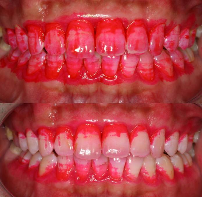 为什么你的牙医总让你洗牙？