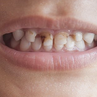 蛀牙、龅牙、地包天......孩童期必须重视的3个牙齿项目
