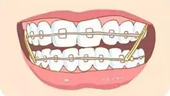 牙齿矫正的最佳年龄段，你知道多少?