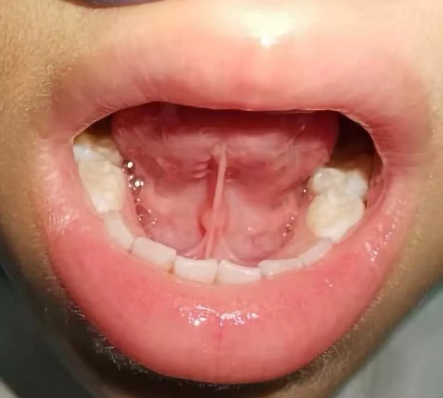 舌系带连着牙龈图片图片