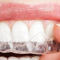 如何选择正确的牙齿矫正器?