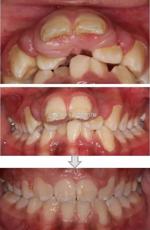 矫正牙齿前，请一字不漏读完这篇！你想知道的硬知识都在这里