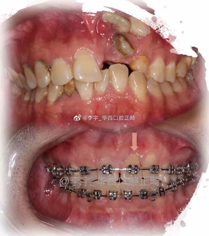 矫正牙齿前，请一字不漏读完这篇！你想知道的硬知识都在这里