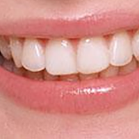 　成人牙齿正畸真的堪比整容吗？你又了解多少？