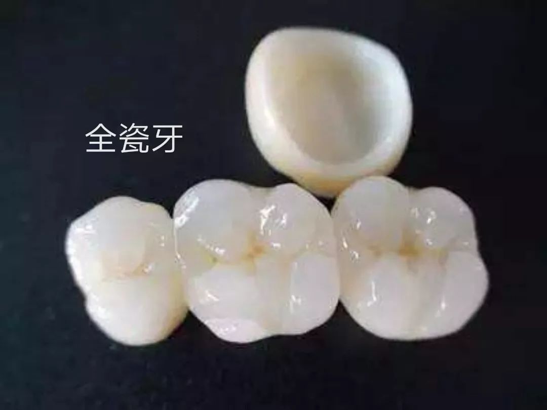 中国人最常见的烤瓷牙，评价褒贬不一，牙医告诉你该做还是不该做？