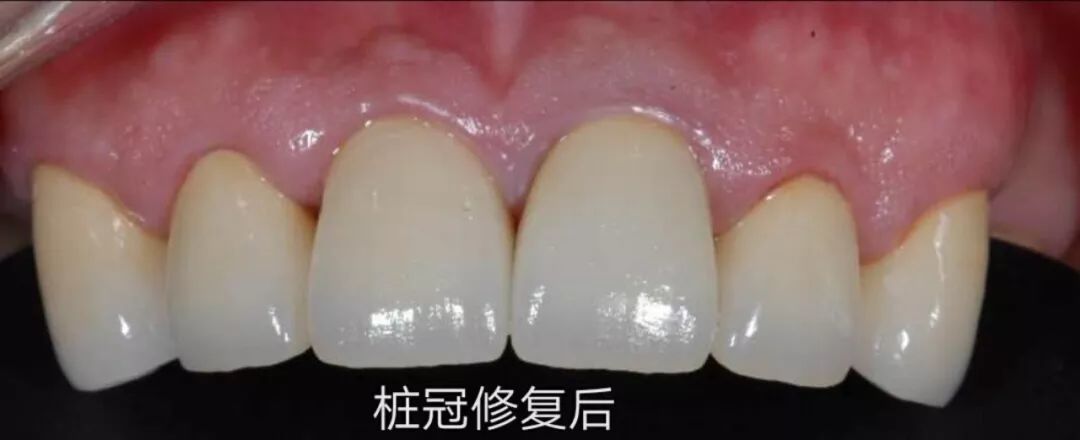 中国人最常见的烤瓷牙，评价褒贬不一，牙医告诉你该做还是不该做？