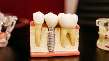 你绝不知道的种植牙内幕揭秘！三甲牙医告诉你种植牙的品牌选择与收费！