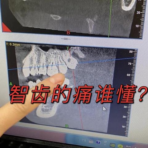 智齿的痛谁懂？快速、优惠拔牙经历分享