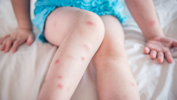 孩子总被蚊子咬，红肿瘙痒？教你3招止痒、消肿！