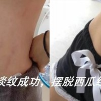 妊娠纹怎么消除？淡化妊娠纹哪个牌子好？