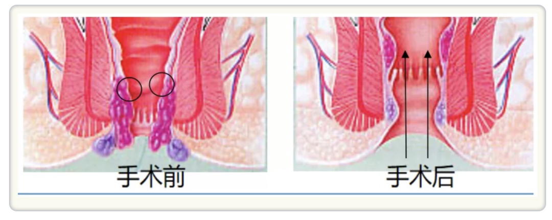 十人九痔？痔疮经常反复？你想要的所有干货内容都在这里了